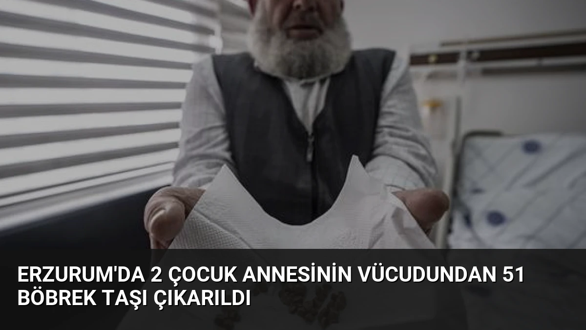 Erzurum’da 2 Çocuk Annesinin Vücudundan 51 Böbrek Taşı Çıkarıldı