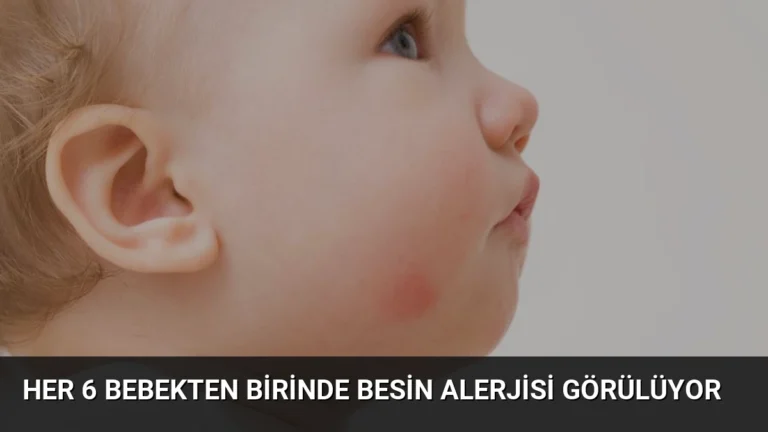Her 6 Bebekten Birinde Besin Alerjisi Görülüyor