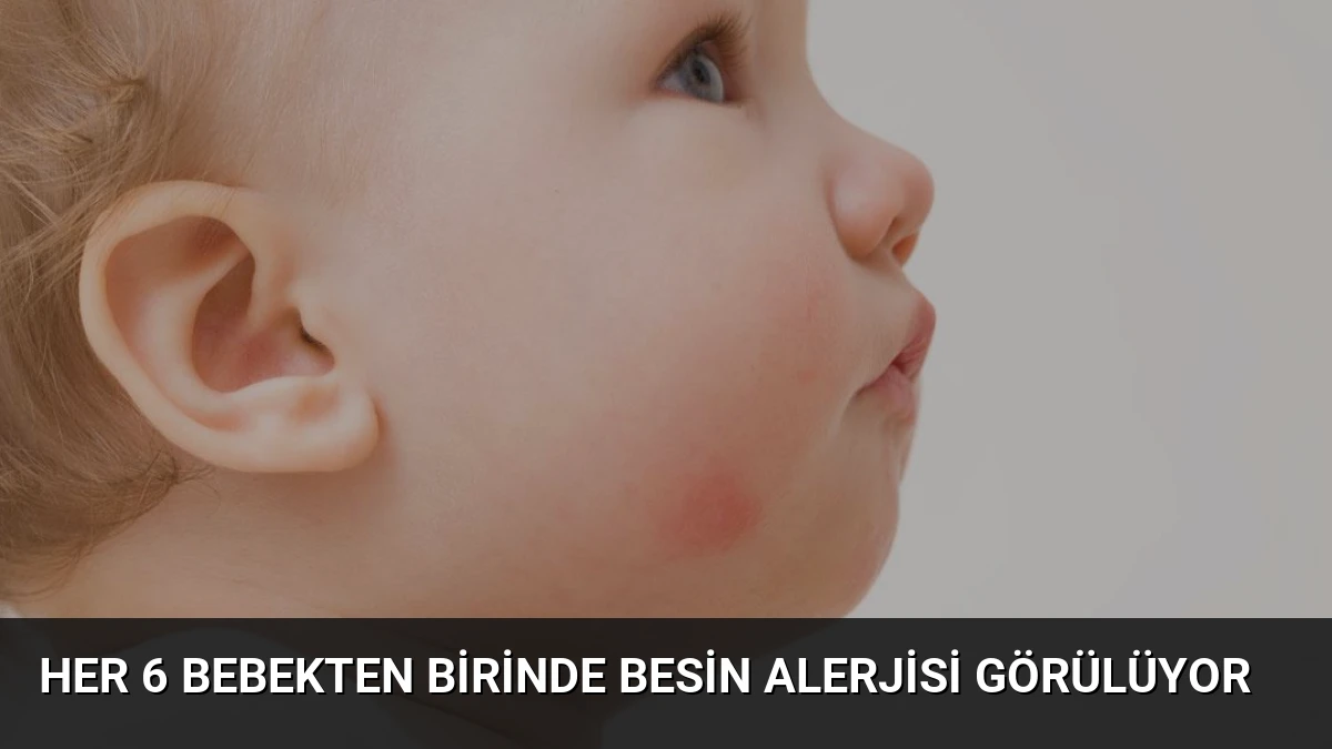 Her 6 Bebekten Birinde Besin Alerjisi Görülüyor